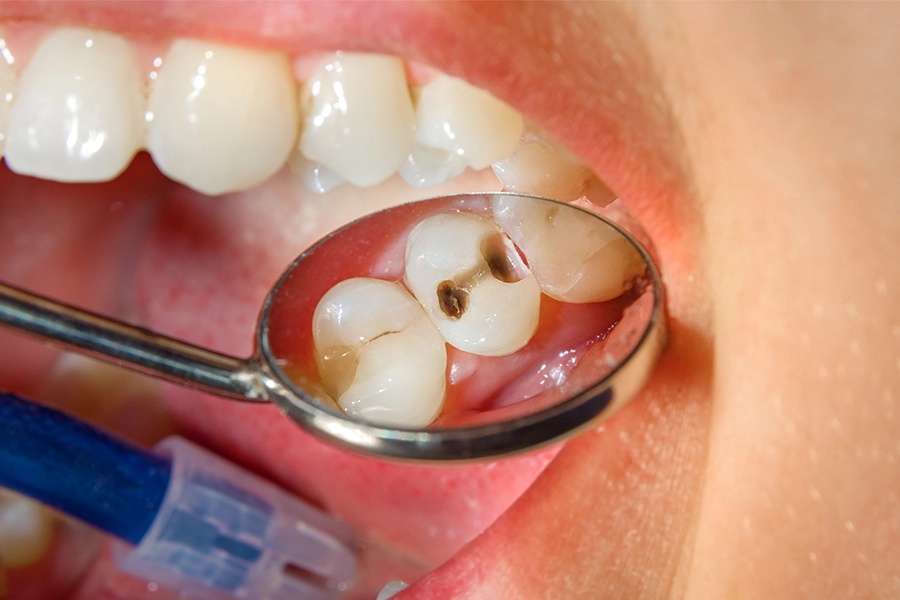 2.虫歯の範囲が大きい場合